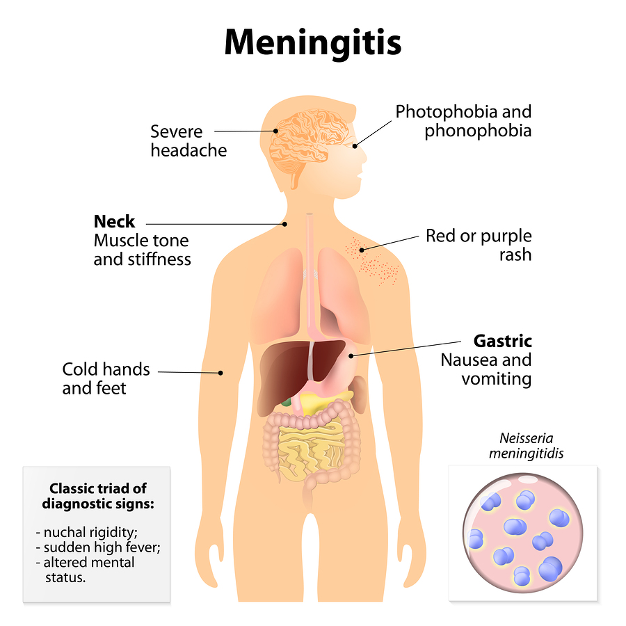 Meningitis symptoms