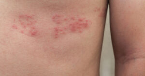 What are Shingles