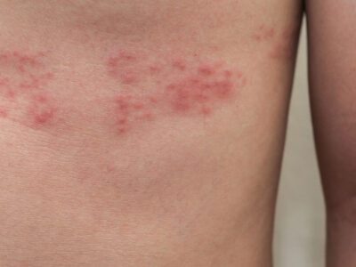 What are Shingles