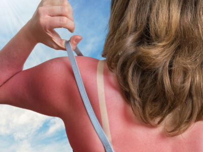 Avoiding Skin Cancer